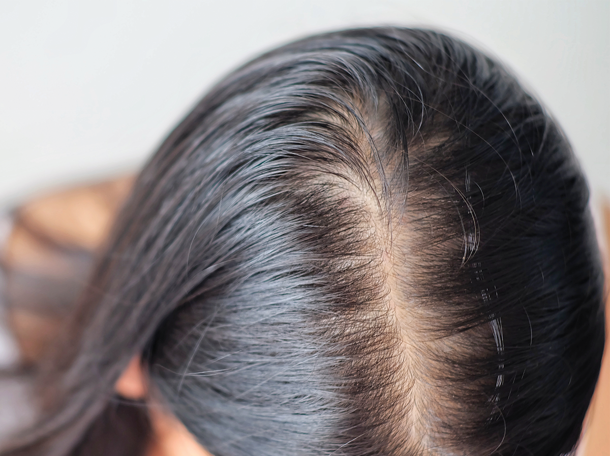 Does Iron Deficiency Cause Hair Loss What Are Hair Restoration Treatments